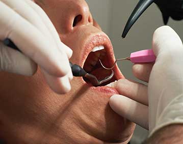 dental fillings